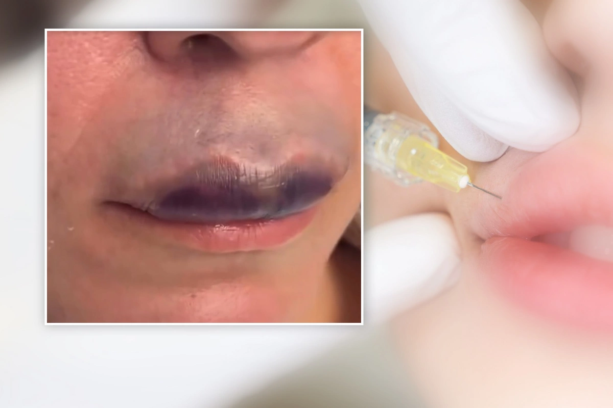 Azərbaycanda daha bir qadın estetik əməliyyatın qurbanı oldu - Dodağı göyərdi